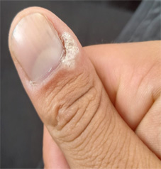 nail warts
