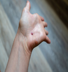Palmar Warts