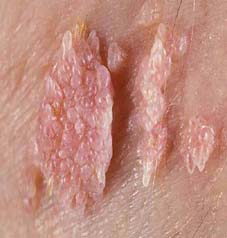 Genital Warts