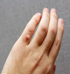Finger Warts