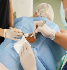 Surgical Treatment of Warts